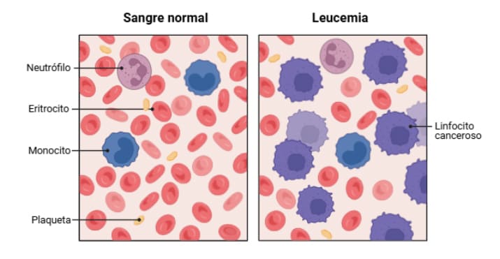comparación entre sangre normal y sangre con leucemia