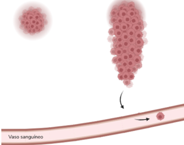tumor maligno