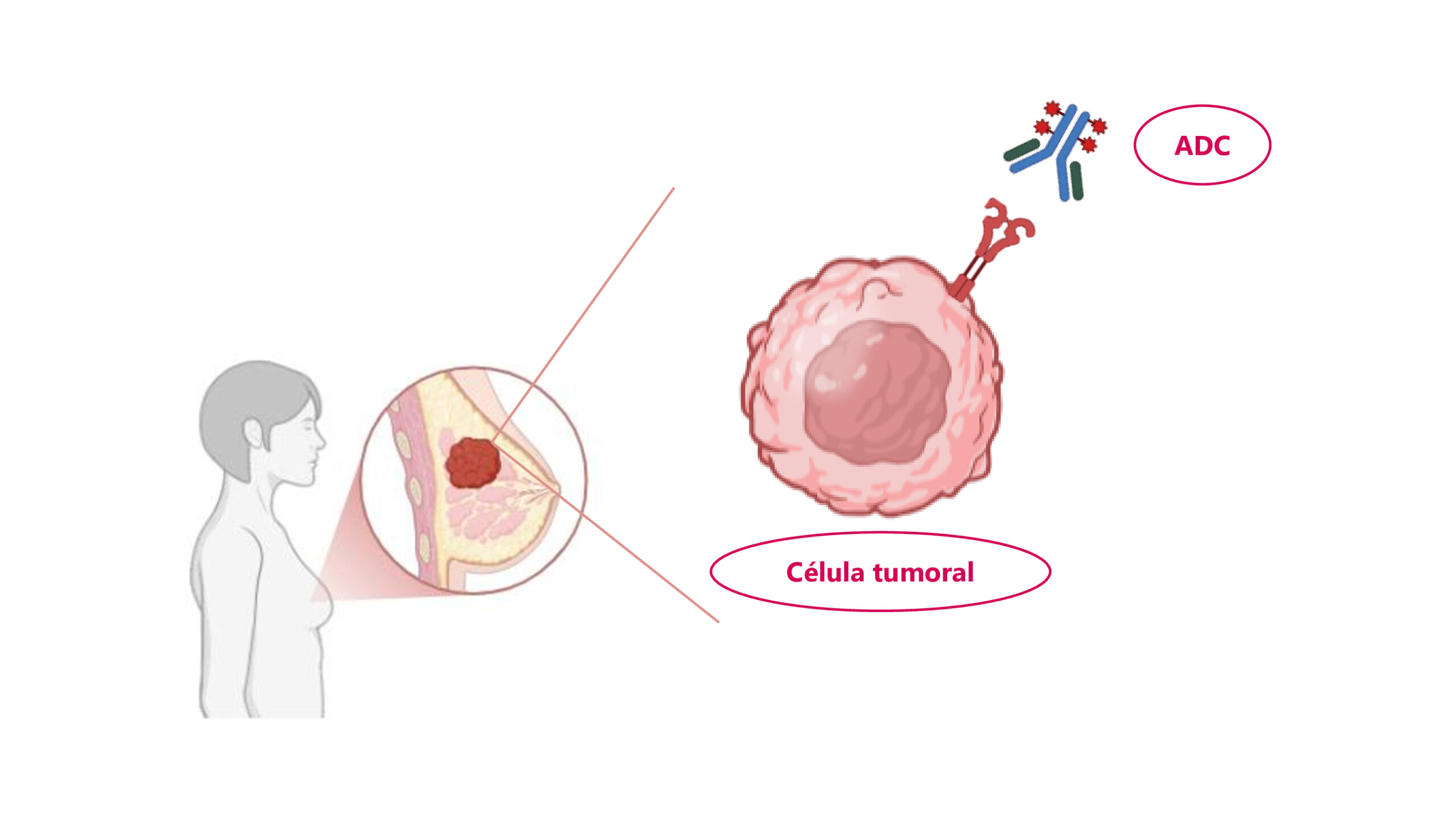 conjugados anticuerpo fármaco ADCs en cáncer de mama